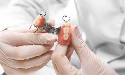 Zubni implanti ili parcijalna proteza? Kada izabrati koje rešenje?