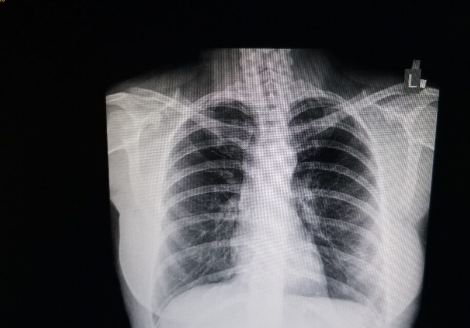 SKRINING ZA RANO OTKRIVANJE RAKA PLUĆA